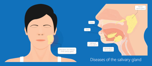 Sialadenitis | ENT Surgeon